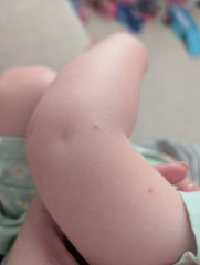 What are these spots on my two year old's arms?