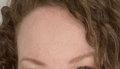 I’m broke, what can take the place of Botox?