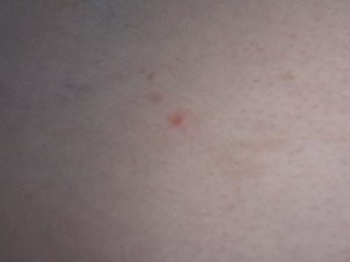 Red spot on back persistant scab please help