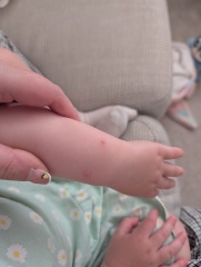 What are these spots on my two year old's arms?