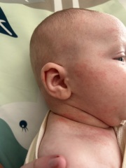 Rash 9 weeks- acne/ eczema/ heat/ allergies
