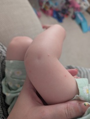 What are these spots on my two year old's arms?