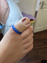 Partial toenail avulsion with phenol