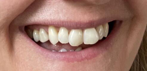 Critique my veneer please (dentists welcome)