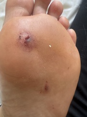 Tweezers punctured my foot and I cannot bear weight