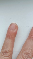 Pathetically small amount of pus generated by self-inflicted infected finger.