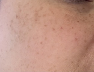 Pigmentation on cheeks despite daily SPF?