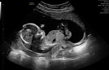 Boy or girl guesses?