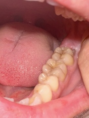 Wisdom tooth deciding to come through at 36 with picture