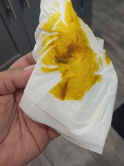 TMI - poop pic included. Is this IBS or BAM?