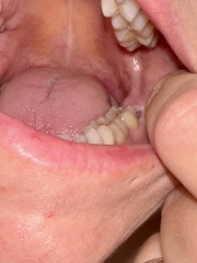 Wisdom tooth deciding to come through at 36 with picture