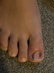 Partial toenail avulsion with phenol