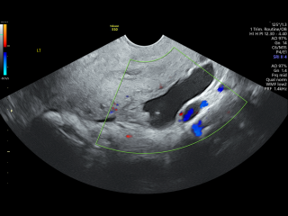 Private scan at 6 weeks from last period and possible ectopic pregnancy concerns