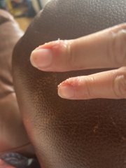 Peeling finger after pompholyx eczema flare