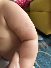 Bumps on upper arm