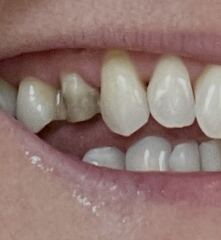 Critique my veneer please (dentists welcome)