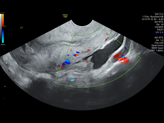 Private scan at 6 weeks from last period and possible ectopic pregnancy concerns