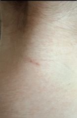 What would cause a bite like this?