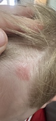 Red itchy rash on son