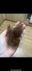 Hair loss after septic shock and ICU recovery, any advice?