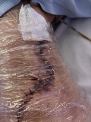 Chronic wound after dog attack, 6 months later