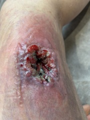Chronic wound after dog attack, 6 months later