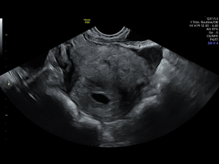 Private scan at 6 weeks from last period and possible ectopic pregnancy concerns