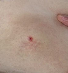 To not go to GP for breast lump?  Think it is infected - photos