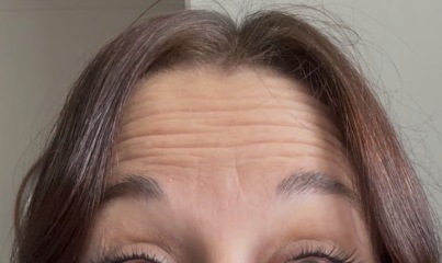 First time Botox for upper face - any experiences or advice?
