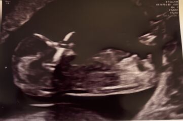 Nub theory guesses from 13 week scan?!