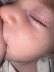 Herpe or spot newborn