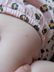 Chicken pox or something else??