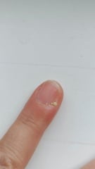 Pathetically small amount of pus generated by self-inflicted infected finger.