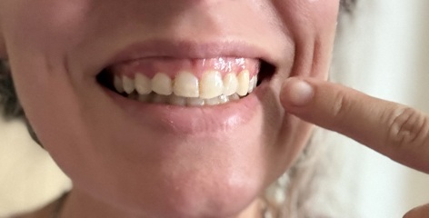 Adult braces - experience