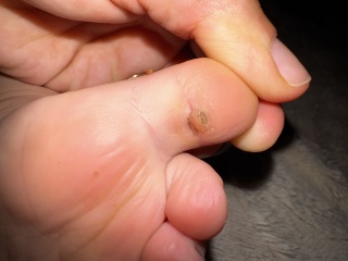 Hard sensitive spot under my two year old’s toe