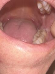 Has anyone had impacted wisdom teeth out ?