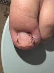Partial toenail avulsion with phenol