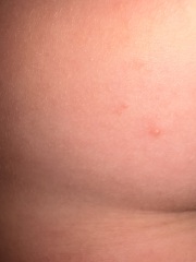 Could this be a second, milder case of chickenpox in my son?