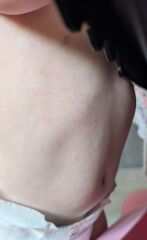 Amoxicillin rash