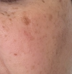 Pigmentation on cheeks despite daily SPF?