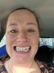 Adult braces - experience