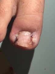 Partial toenail avulsion with phenol