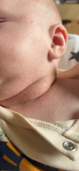 Rash 9 weeks- acne/ eczema/ heat/ allergies