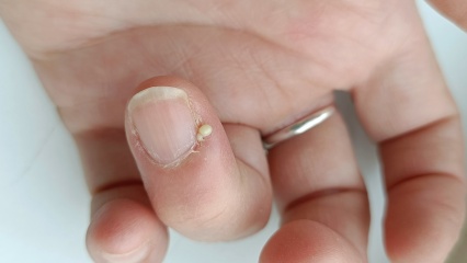 Pathetically small amount of pus generated by self-inflicted infected finger.