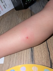 Advice after allergic reaction to insect bites in my two-year-old