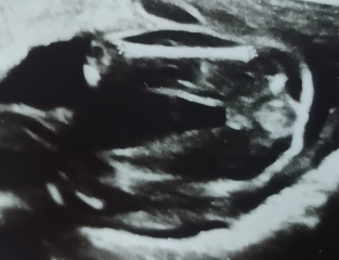 Ladies who have had a gender scan around 16 weeks 
