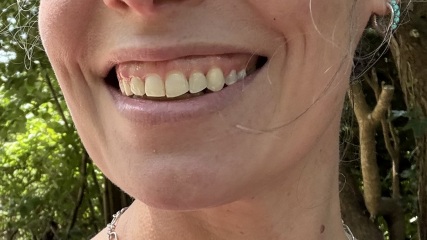 Adult braces - experience