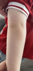 Red itchy rash on son