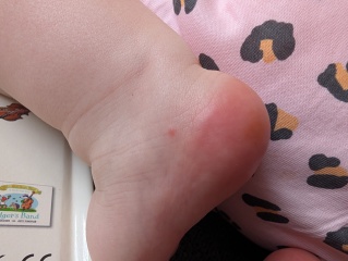 Chicken pox or something else??
