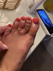 Big blisters all over feet